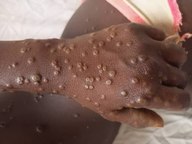 MPOX (Monkeypox) : comprendre la maladie et adopter les bons réflexes
