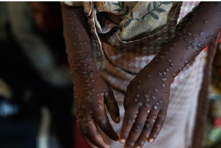 RDC/Santé: Cinq cas atteints du Mpox déjà confirmés à Watsa