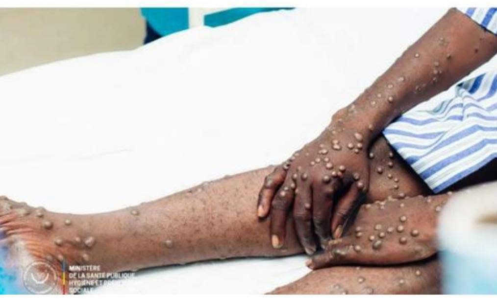 Mpox: 1.500.000 doses de vaccin « LC16m8 » attendues à Kinshasa (ministère de la Santé)