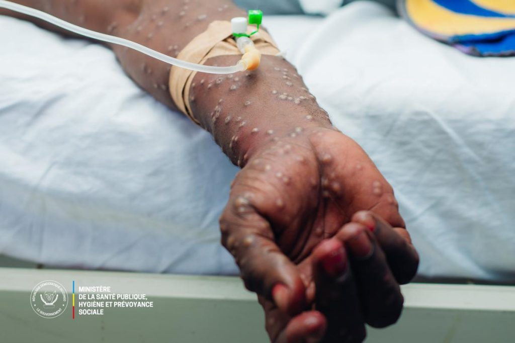 Santé : 30 personnes atteints du Mpox au sein de la prison militaire de Ndolo à Kinshasa