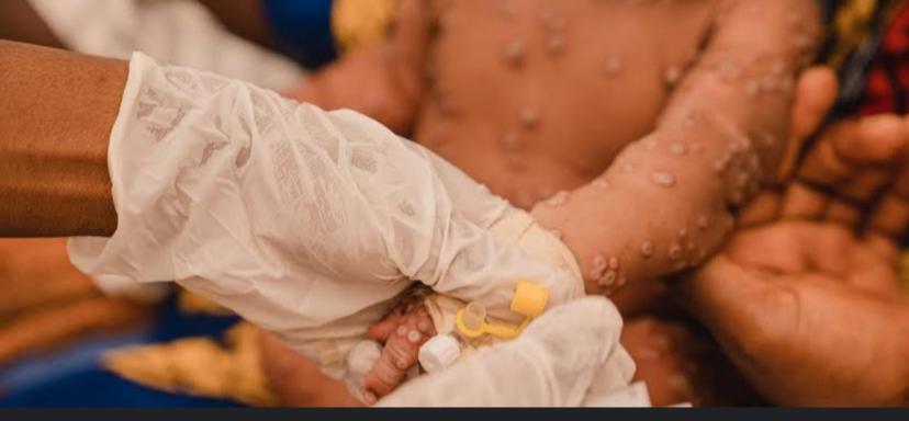 Sud-Kivu : Le Mpox fait 9 100 cas enregistrés depuis janvier et avril 2025 et 13 décès