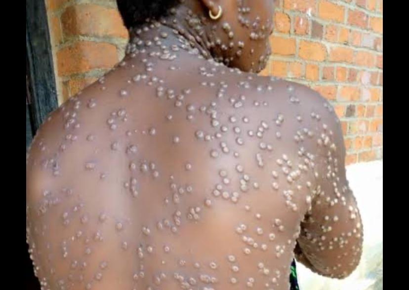 Mpox : La RDC enregistre une tendance nationale à la baisse